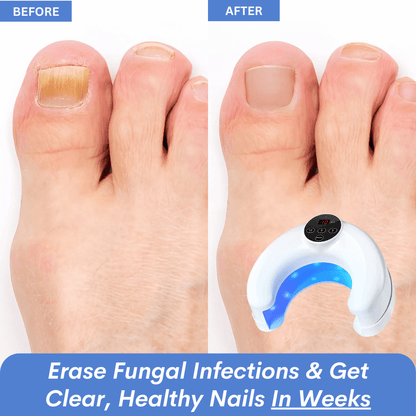 ClearNail Pro Curve™ - Nail Fungus Laser Device